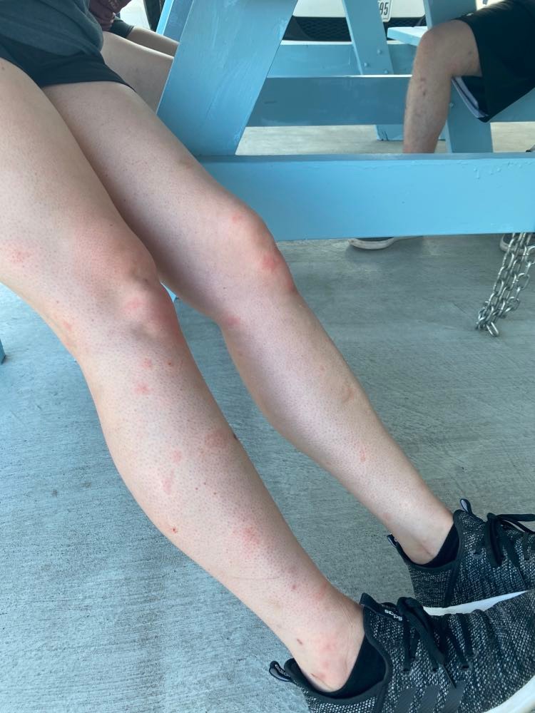 Photo of mosquito bitten legs